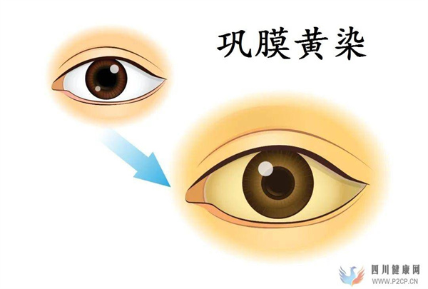 肝病患者的皮膚癥狀與肝病治療(圖1)