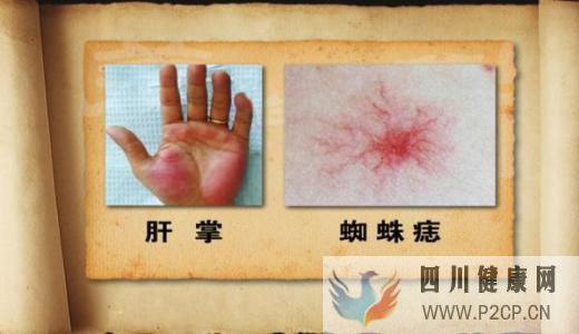 肝病多數是“拖”出來的,肝病的7個癥狀,你占了幾...(圖5)