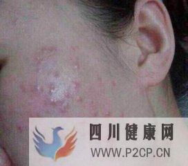 過敏的八大典型癥狀及應對法則!(圖3)