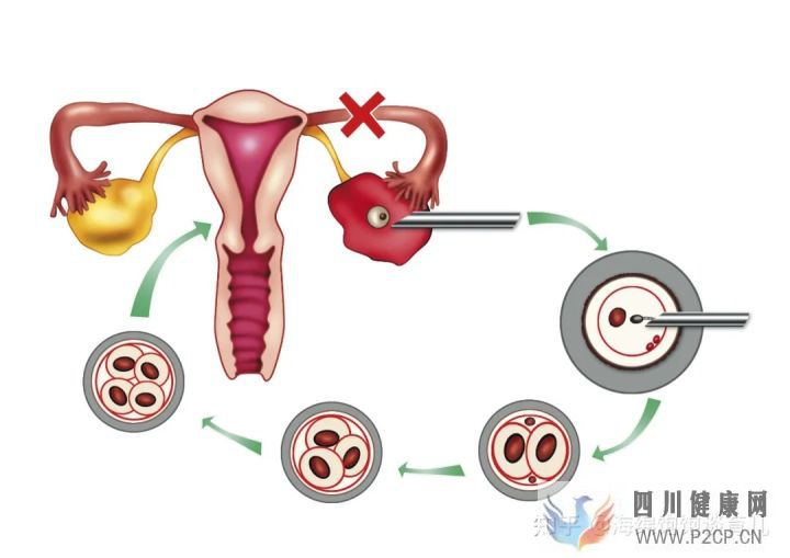 試管嬰兒1代、2代、3代、4代哪個(gè)最好真實(shí)操作過...(第二代試管嬰兒成功率有多少)(圖8)