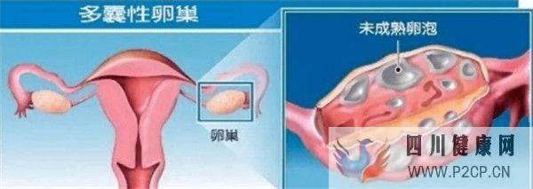 多囊卵巢綜合征對試管嬰兒成功率有哪些影響如何及時調理(38歲做試管嬰兒成功率有多少)(圖1)