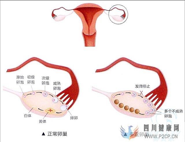 多囊卵巢綜合癥能做試管嬰兒嗎？成功率多少(38歲做試管嬰兒成功率有多少)(圖1)