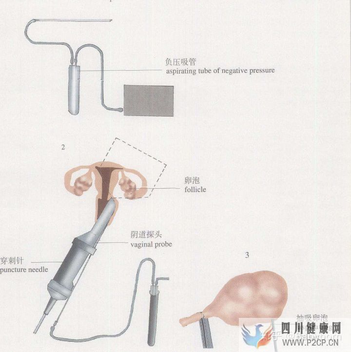 干貨女性取卵全過(guò)程(兩個(gè)女生試管嬰兒怎么做的全過(guò)程)(圖5) 干貨女性取卵全過(guò)程(兩個(gè)女生試管嬰兒怎么做的全過(guò)程)(圖5)
