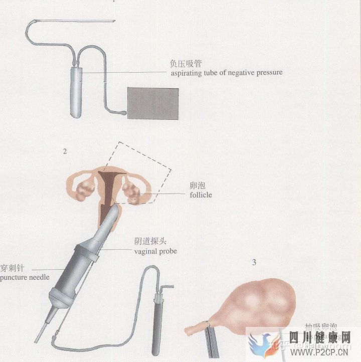 干貨女性取卵全過(guò)程(兩個(gè)女生試管嬰兒怎么做的全過(guò)程)(圖6) 干貨女性取卵全過(guò)程(兩個(gè)女生試管嬰兒怎么做的全過(guò)程)(圖6)