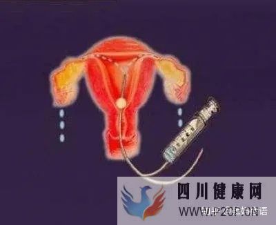 輸卵管堵塞到底是先做手術,還是直接試管嬰兒(女方輸卵管堵塞做試管嬰兒需要多長時間)(圖5) 輸卵管堵塞到底是先做手術,還是直接試管嬰兒(女方輸卵管堵塞做試管嬰兒需要多長時間)(圖5)