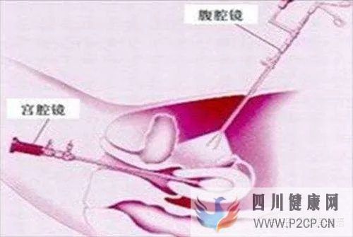 輸卵管堵塞到底是先做手術,還是直接試管嬰兒(女方輸卵管堵塞做試管嬰兒需要多長時間)(圖7) 輸卵管堵塞到底是先做手術,還是直接試管嬰兒(女方輸卵管堵塞做試管嬰兒需要多長時間)(圖7)