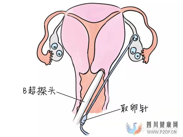 很多人說試管嬰兒可能不會是自己親生的,這是真的...(試管嬰兒90%不是自己的)(圖1)