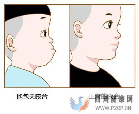 地包天對口腔的影響比你想的要大！(圖1)