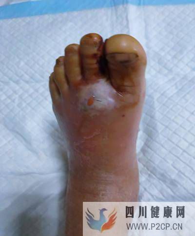 糖尿病患者出現(xiàn)浮腫，要警惕是糖尿病腎病惹的禍(圖1)