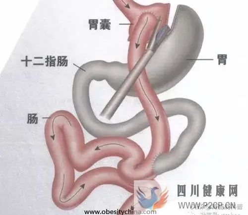 手術也能治糖尿病？一文了解——胃旁路術(圖1)