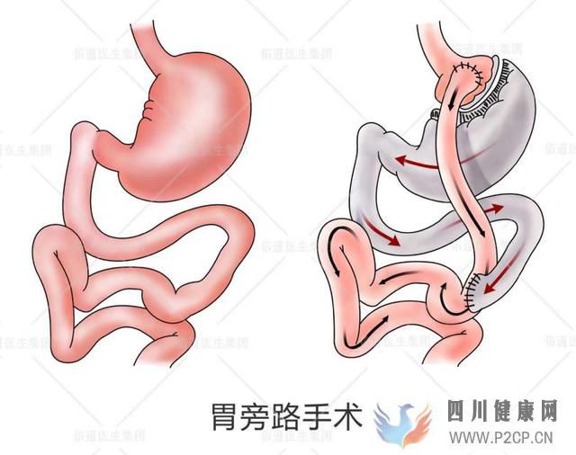 這個方法不僅能減肥，還能治糖尿病！(圖1)