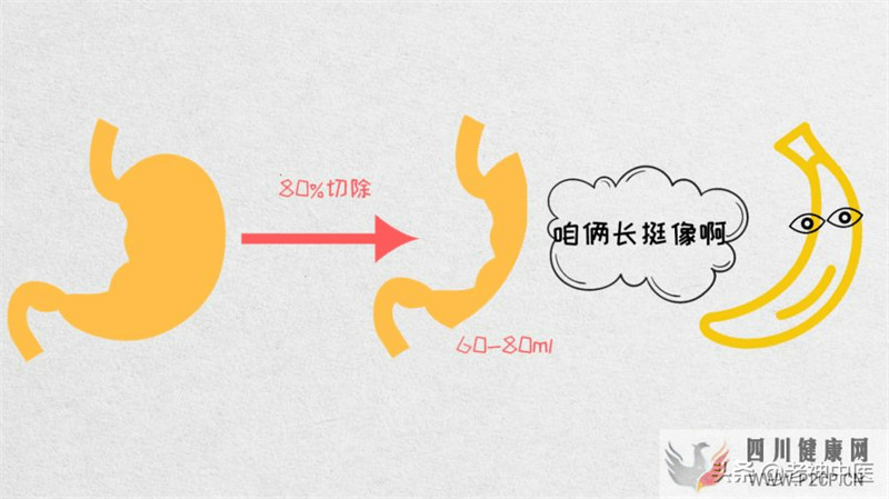 手術治療糖尿病，可以根治糖尿病嗎？(圖2)
