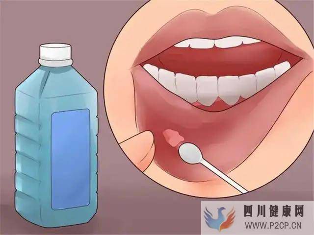 口腔炎、口腔潰瘍怎么治？(圖1)