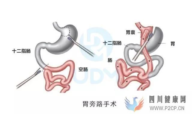 糖尿病的治療方法，胃旁路手術費用多少錢？(圖1)