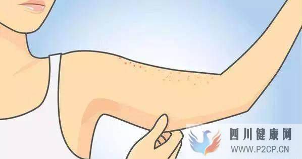 得了雞皮膚怎么辦？如何改善難纏的“雞皮膚”？(圖1)