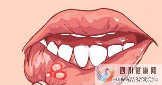 口腔潰瘍，火辣辣的疼—義烏傅氏口腔(圖1)