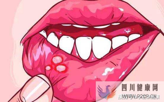 口腔潰瘍是怎么引起的？口腔潰瘍有哪些危害？(圖1)