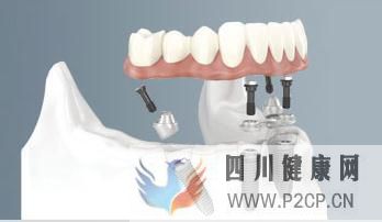 糖尿病對(duì)人工種植牙的影響(圖1)