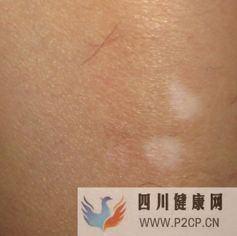 白癜風初期的癥狀是什么樣的(圖1)