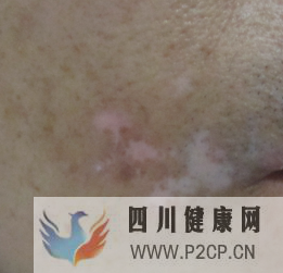 不同時期的白癜風(fēng)癥狀是什么樣的(圖1) 不同時期的白癜風(fēng)癥狀是什么樣的(圖1)