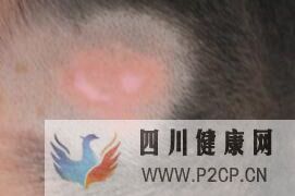 兒童白癜風早期癥狀是什么樣的(圖1) 兒童白癜風早期癥狀是什么樣的(圖1)