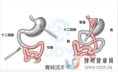 糖尿病手術(shù)治療，血糖高可以治好嗎(圖1)