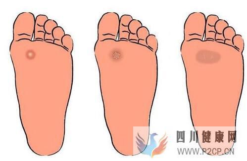 糖尿病在出現爛腳這個并發癥之前有什么征兆沒有？(圖1)