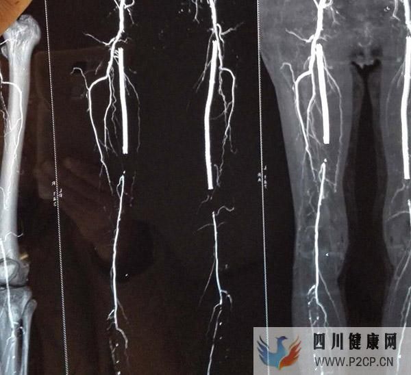 糖尿病并發癥足部潰瘍的早期病因有哪些？(圖2)