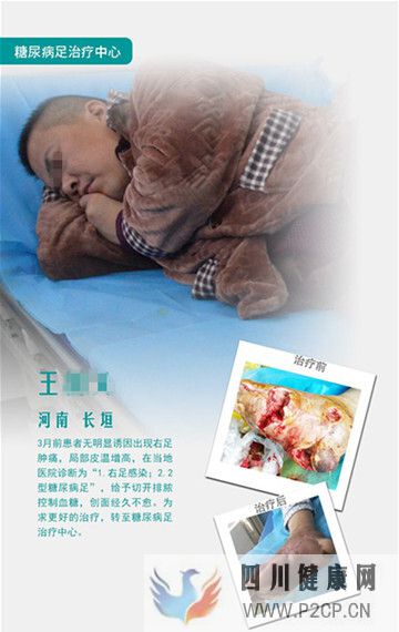 糖尿病足真的能治好嗎？(圖2)