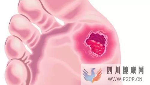 糖尿病出現的爛腳不愈合該怎么治療？(圖1)