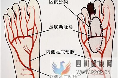糖尿病引起的腳趾頭發黑該怎么去治療？(圖1)