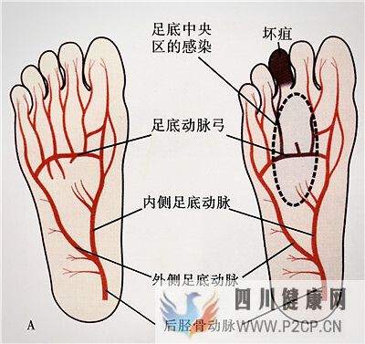 糖尿病引起的腳趾頭發黑該怎么去治療？(圖2)