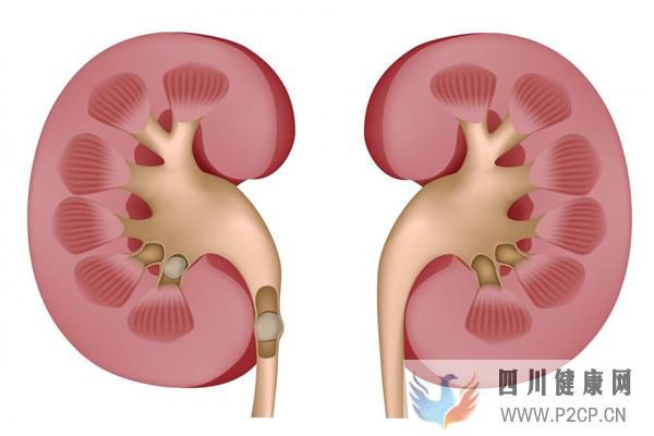 痛風性腎病的危害多多，需要怎么治療才好？(圖2)