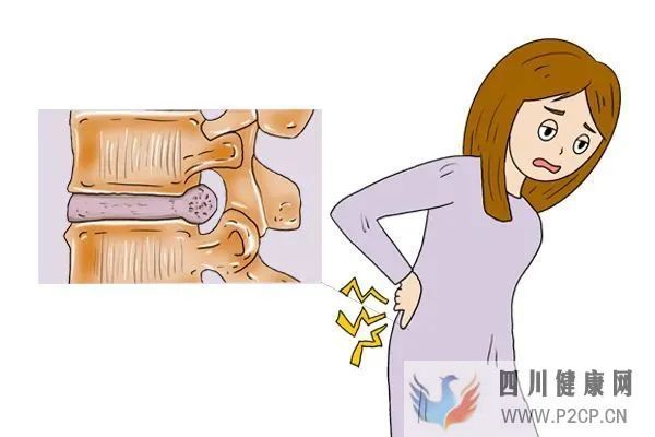 引起腰椎間盤突出的原因是什么(圖1)