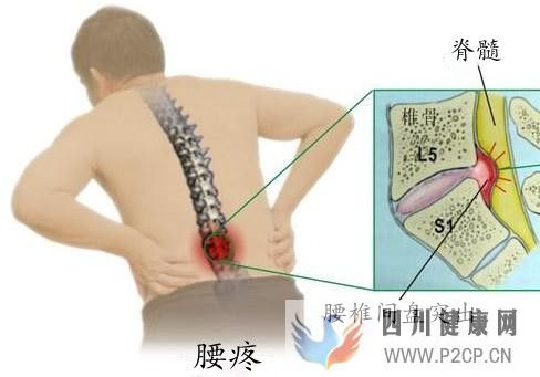 引起腰椎間盤突出的原因是什么(圖4)