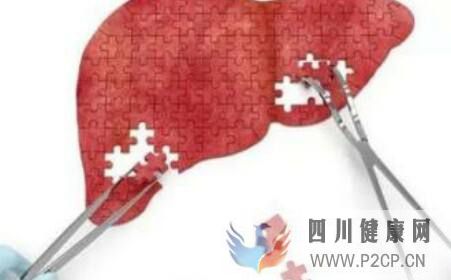 引起肝硬化的原因是什么(圖1)