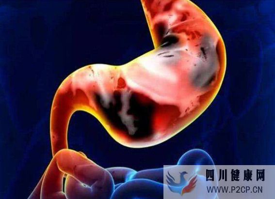 了解胃癌早期癥狀，胃癌發生之前身體有哪些不適癥狀表現(圖1)