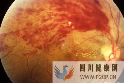 糖尿病視網膜病變能治好嗎糖尿病視網膜病變的預防護理(圖2)