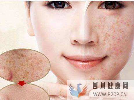 激素臉好的癥狀有哪些激素臉怎么有效治療(圖2)