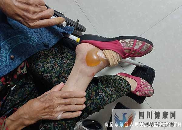 糖尿病足為什么很難治？怎么治療才能好？(圖1)