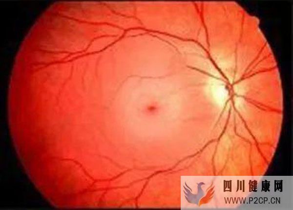 男子眼睛視力下降查出糖尿病，高血糖為何會傷眼？中醫辨證療法(圖1)