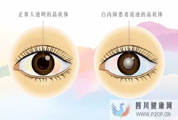 男子眼睛視力下降查出糖尿病，高血糖為何會傷眼？中醫辨證療法(圖3)