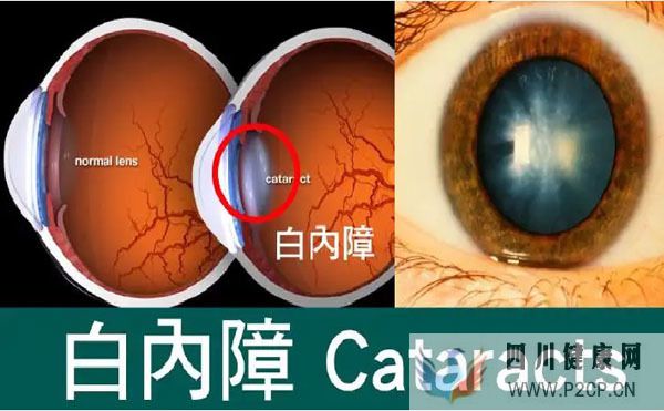 男子眼睛視力下降查出糖尿病，高血糖為何會傷眼？中醫辨證療法(圖4)