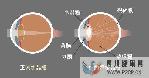 白內(nèi)障的這些常識你了解嗎？(圖1)