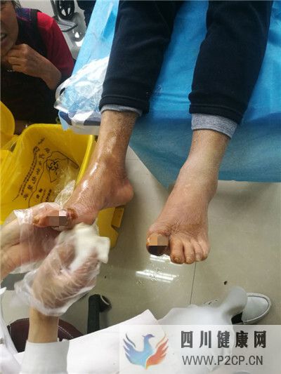 糖尿病患者雙腳大腳趾同時出現發黑潰爛，典型的糖尿病足干性壞疽(圖2)
