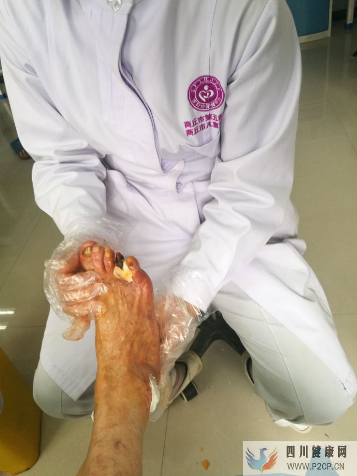 糖尿病患者出現腳趾發黑的現象，是什么原因引起的？(圖2)