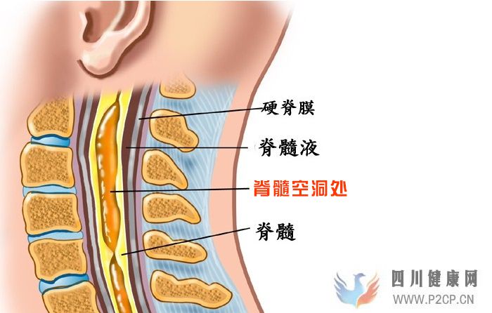 脊髓空洞癥診療中心：脊髓空洞癥的早期都有哪些癥狀呢應該怎么辦(圖1)