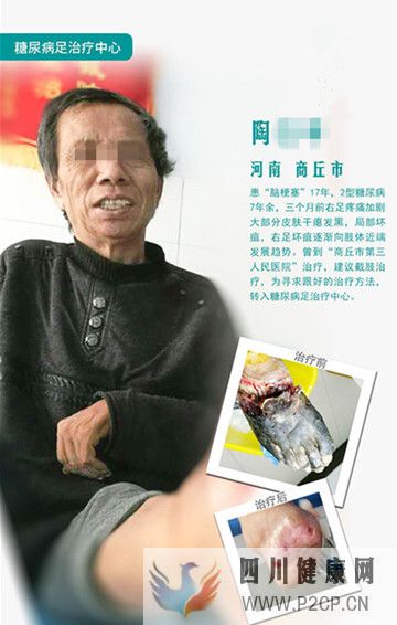 糖尿病患者為什么會得糖尿病足,應該怎么治療?(圖1) 糖尿病患者為什么會得糖尿病足,應該怎么治療?(圖1)