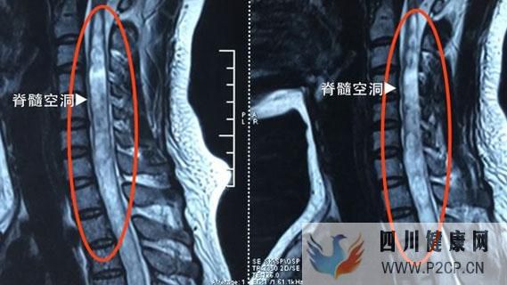 德勝門殷世榮主任：脊髓空洞癥都有哪些癥狀應該怎么辦？(圖1)