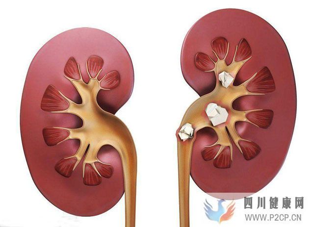 糖尿病患者吃楊桃引發(fā)腎炎，腎病患者哪些蔬菜水果不能吃？(圖1)